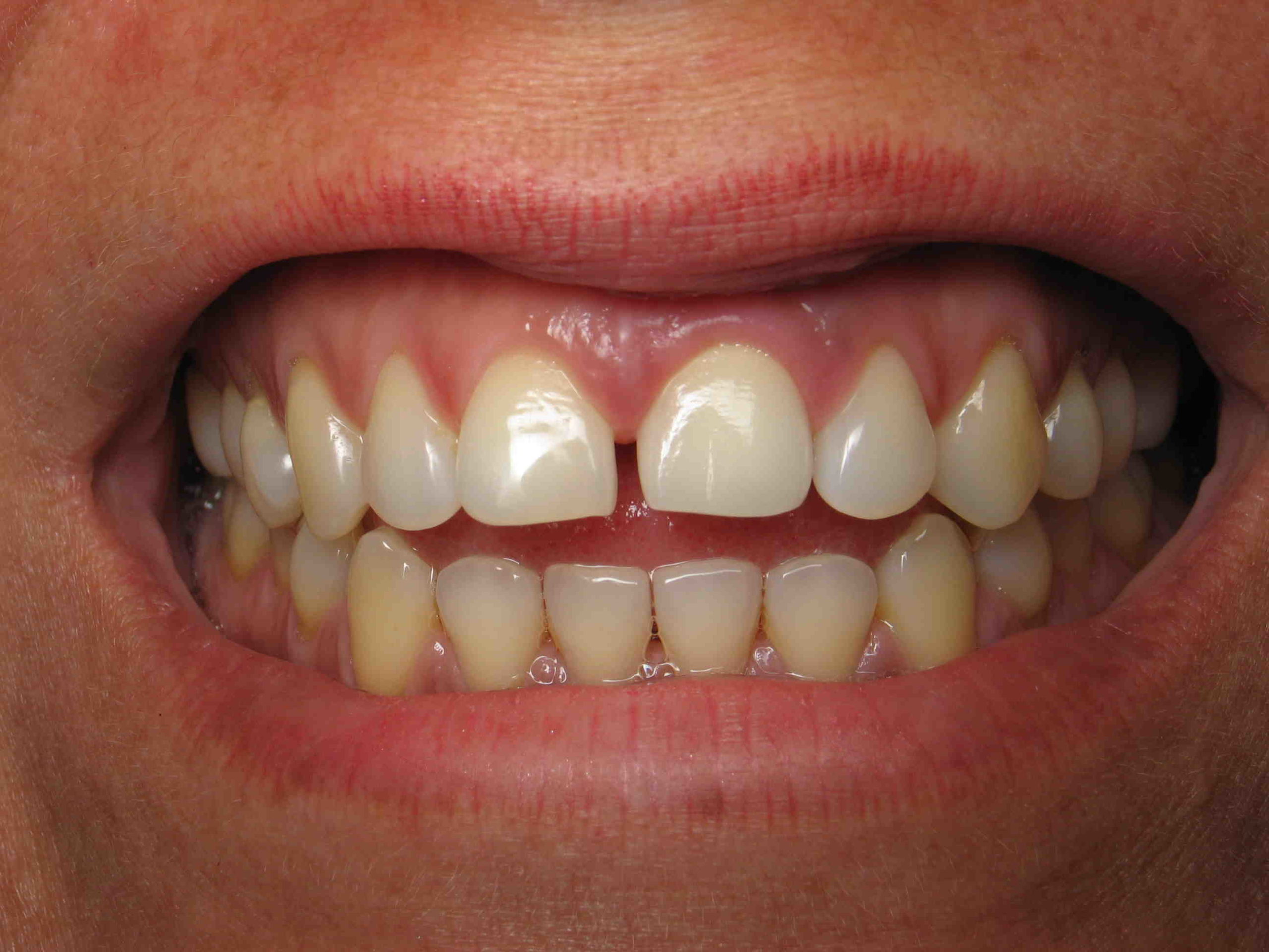 Can a space between teeth be fixed?