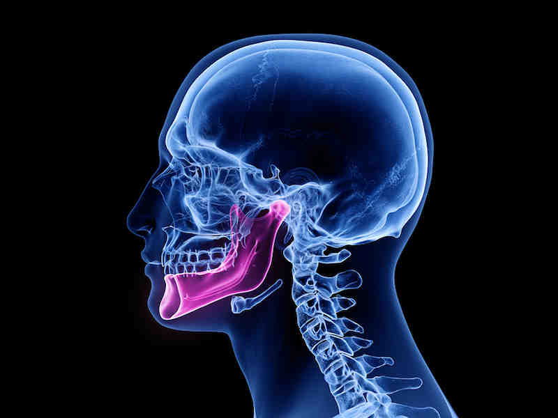 Can bone be built up for implants?