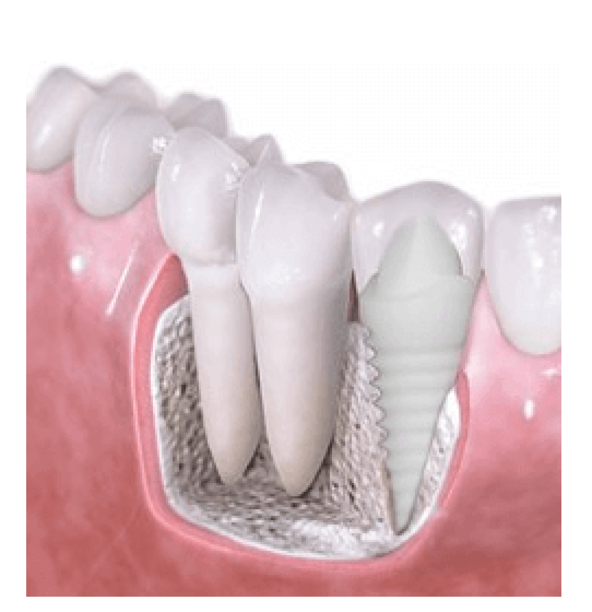 Can bone grow over implants?