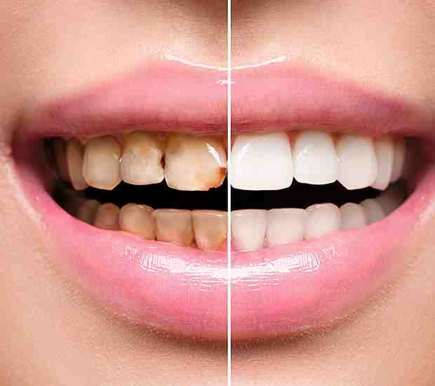 Can dental implant screws come loose?