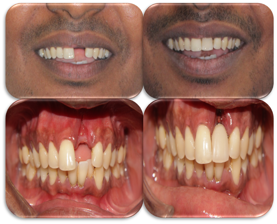 Can dental implants be done in one day?