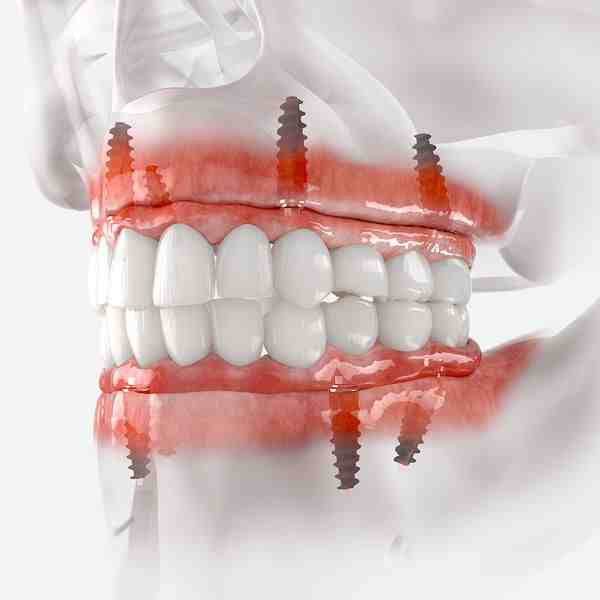 Can dental implants cause heart problems?