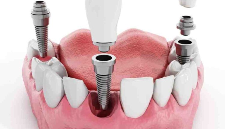 Can dental implants help tmj