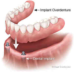 Can dentures be modified?