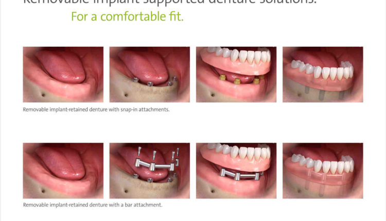 Can i get dental implants using my existing denture