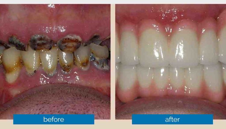 Can i rub my lips together after dental implants