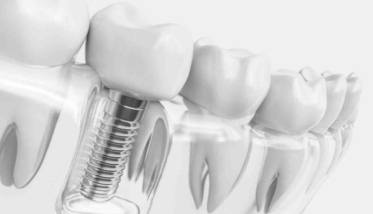 Can i still get dental implants after dentures