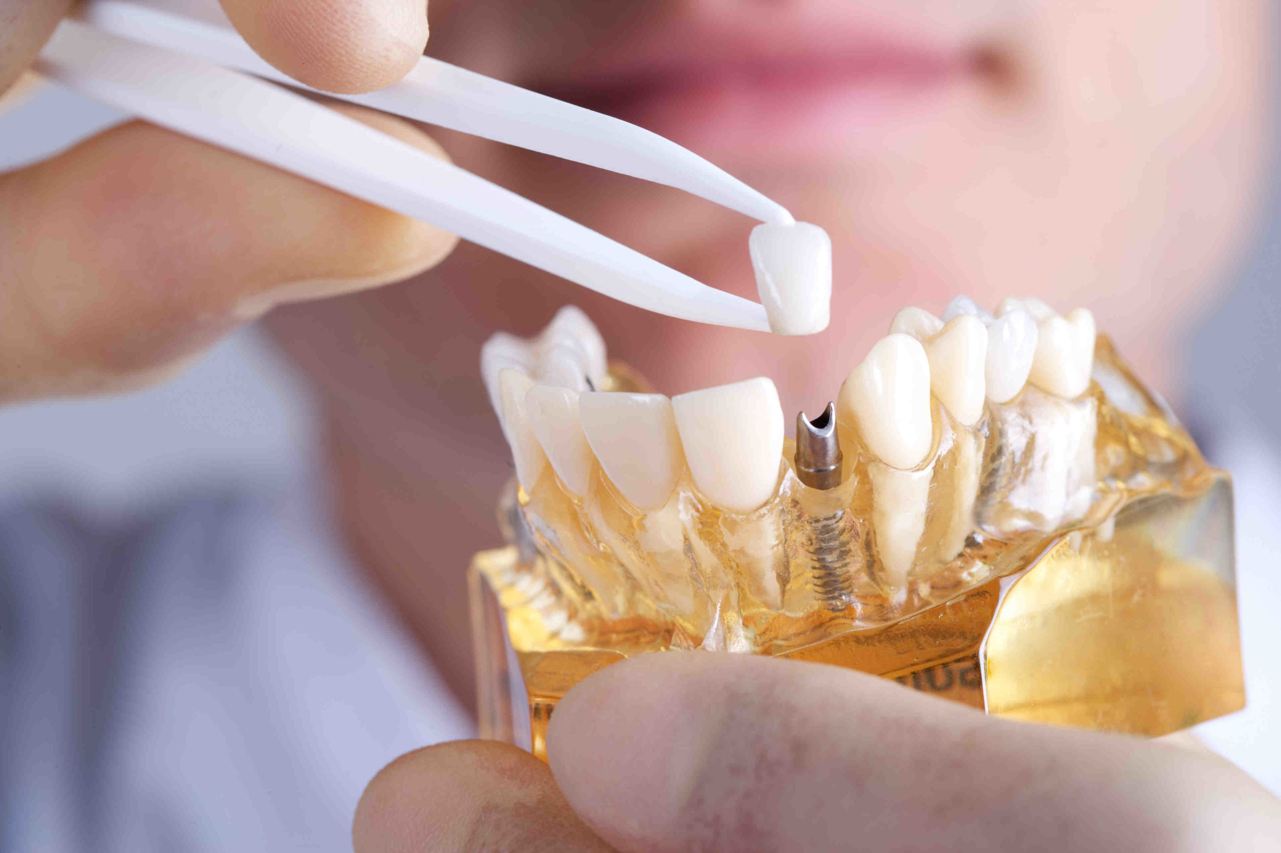 Can teeth gaps close naturally in adults?