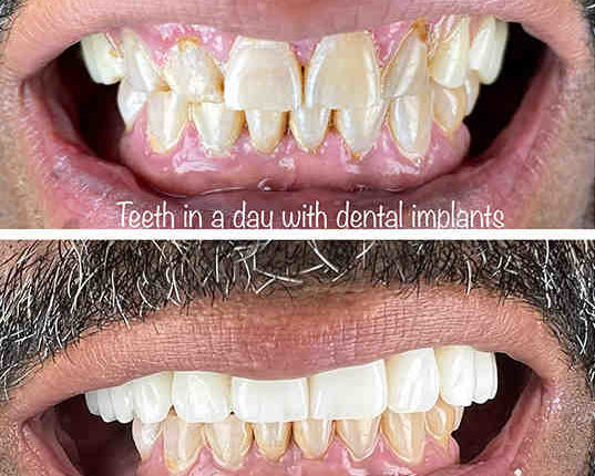 Can temporary dental implants be adjusted to fit?
