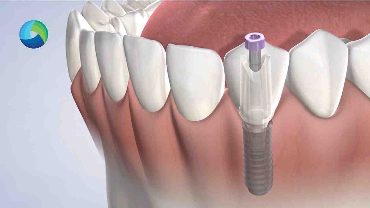 Can you apply tooth gems with Super glue?