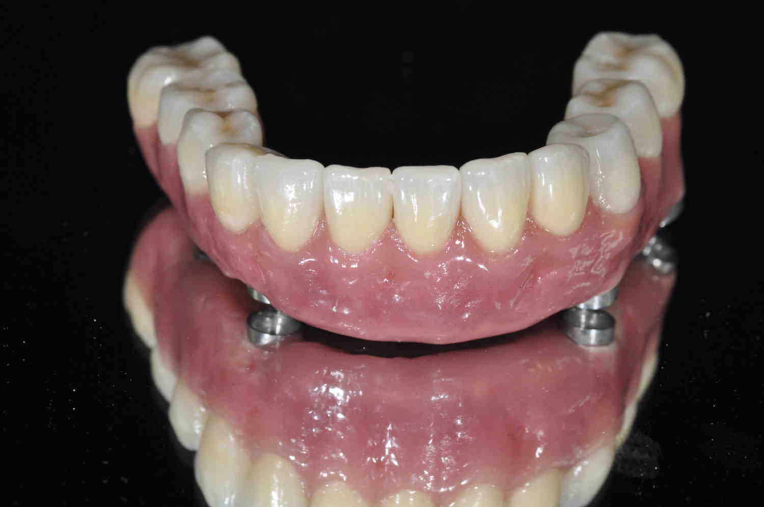 Can you attach a partial to an implant?