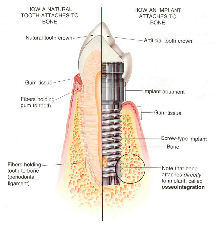Can you brush your teeth after implant surgery?