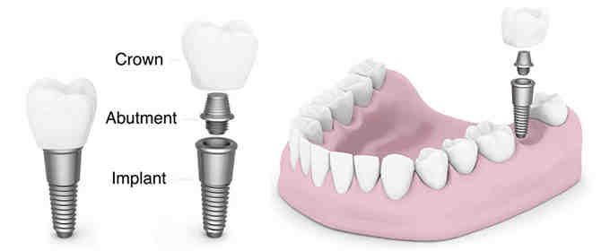 Can you cement your teeth?