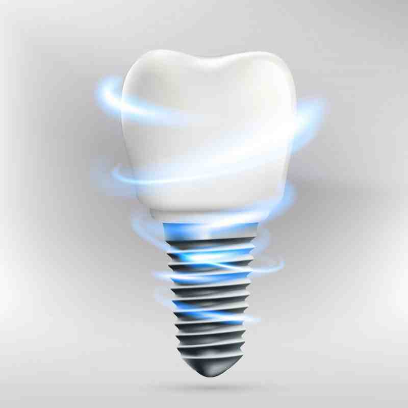 Are dental implants a problem with airport security Dental News Network