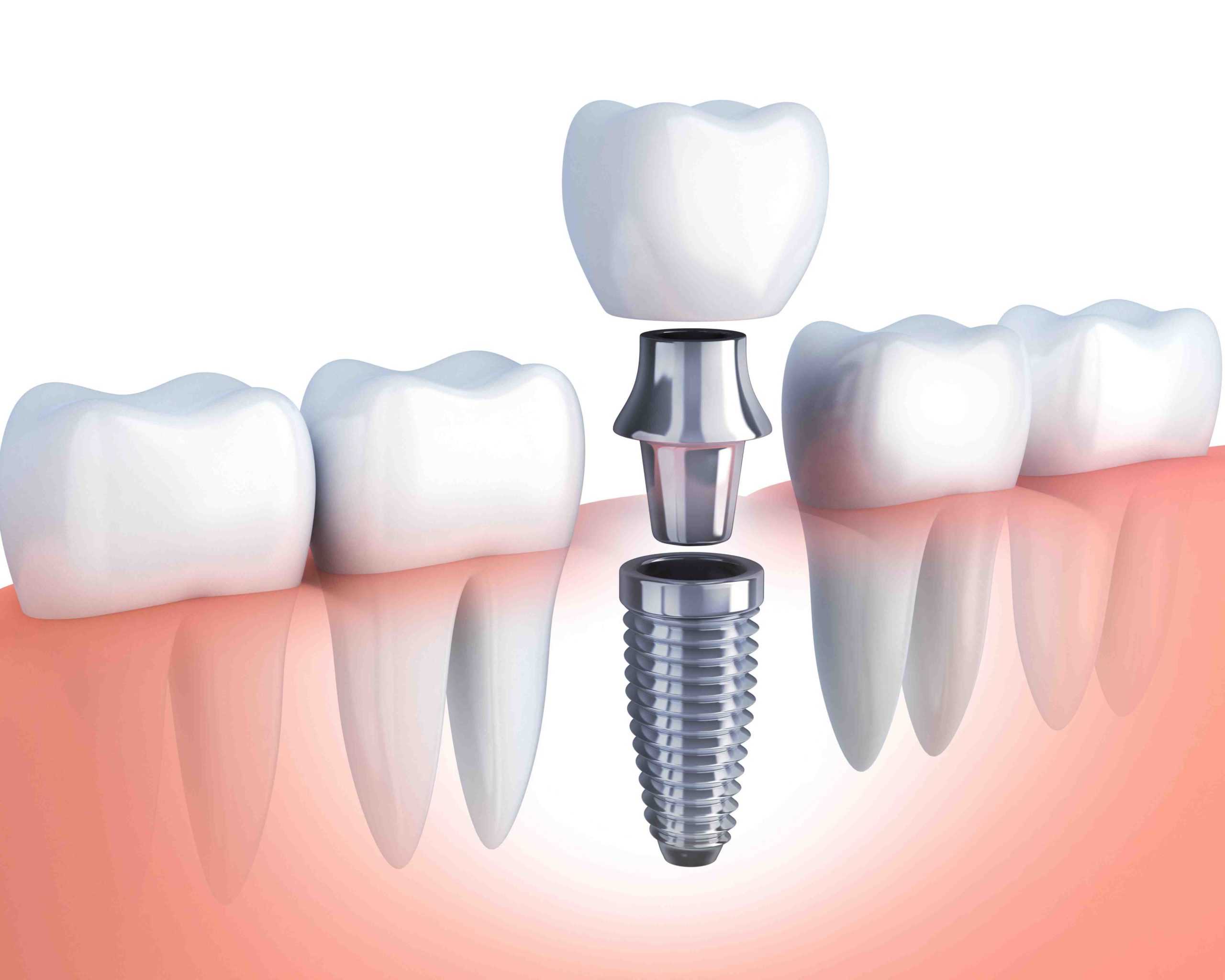 Can you get a dental implant if you have osteoporosis?