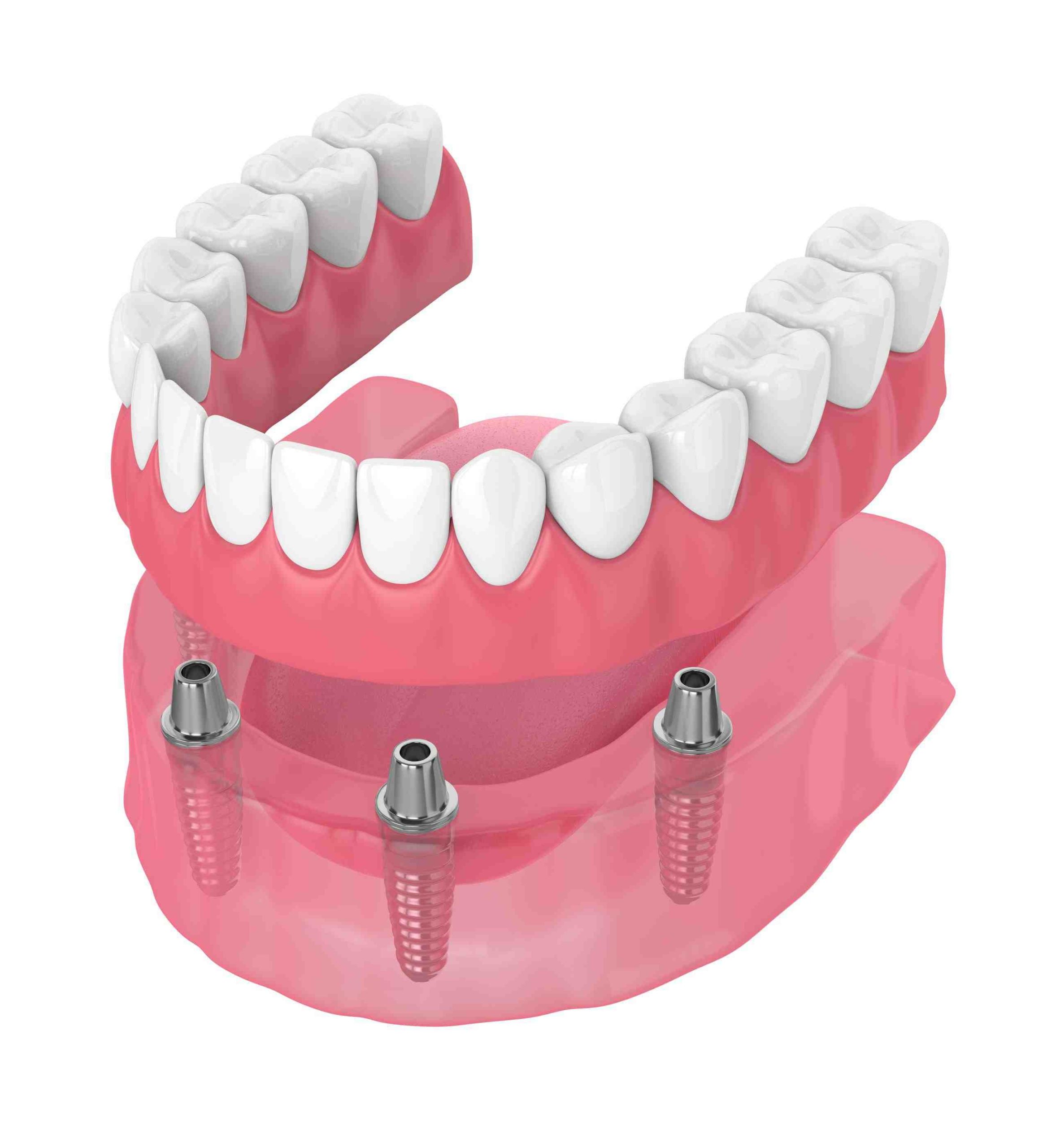 Can you use a Waterpik with implants?