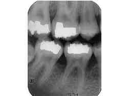 Do bone grafts come from cadavers?