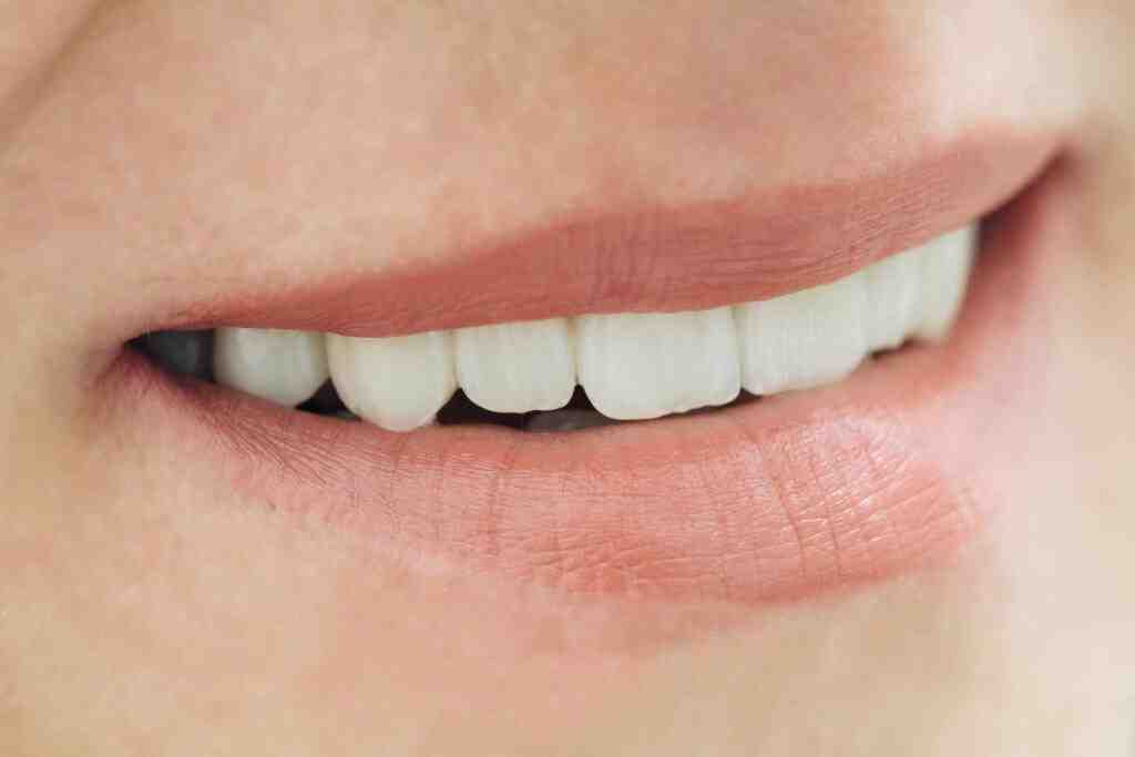 Do composite veneers look fake?