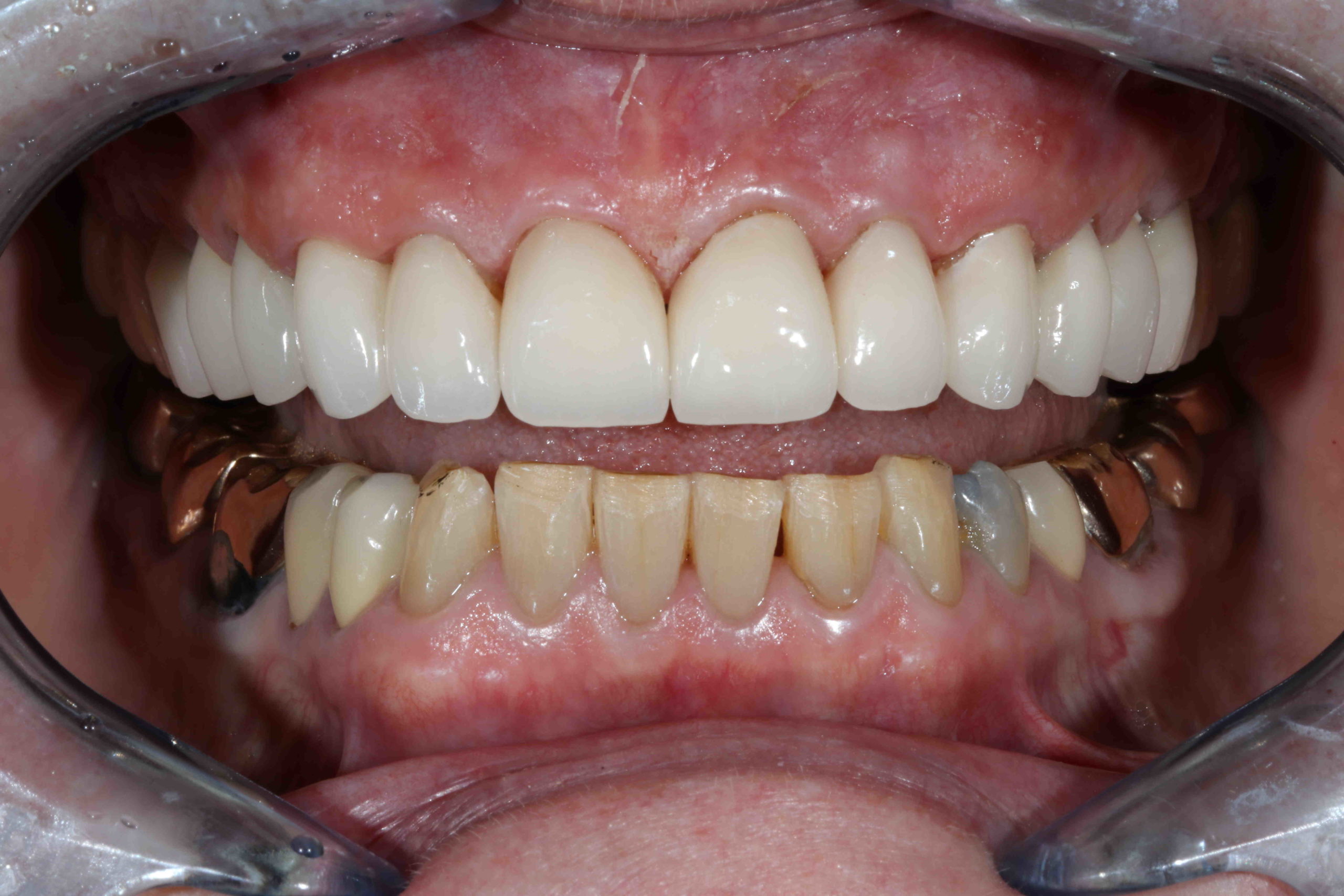 Do crowns make you look younger?