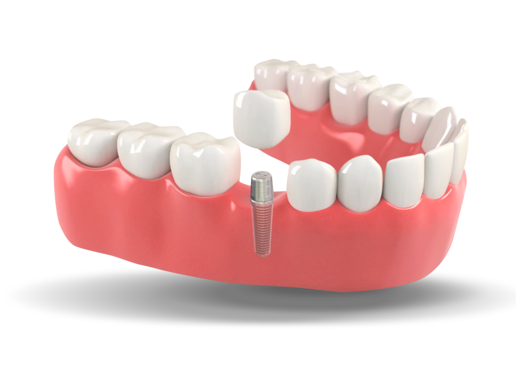 Do dental implants get cavities?