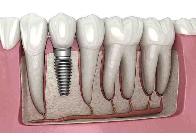 Do dental implants hurt?