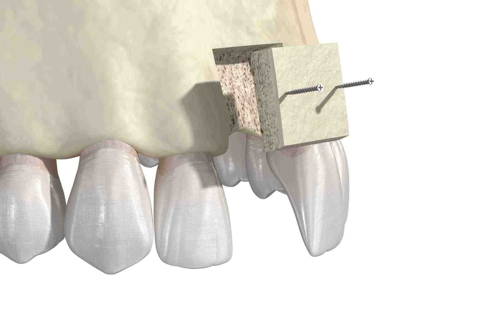 Do dental implants hurt more than tooth extraction?
