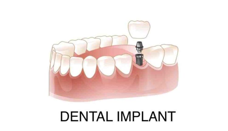 Do dental implants loosen