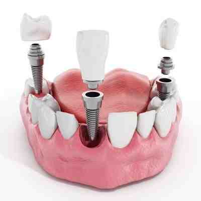 Do gums grow around implants?
