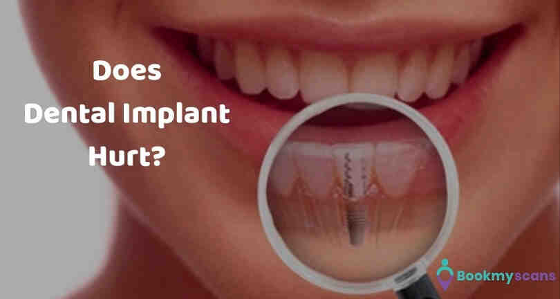 Do gums grow over dental implant?