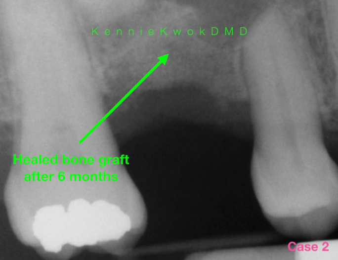 Do gums grow over dental implant?