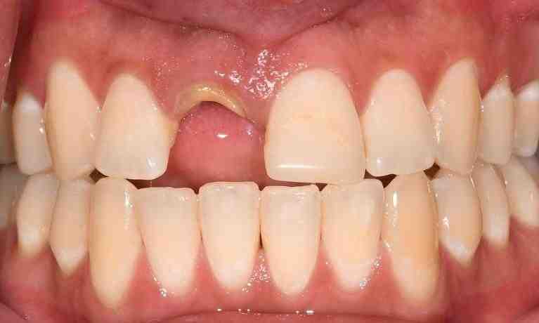 Do porcelain crowns look natural?
