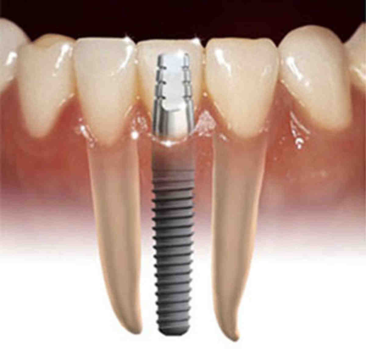 Does Delta Dental cover implants?