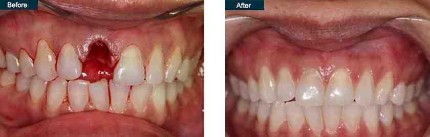 how-much-for-implants-dental-dental-news-network