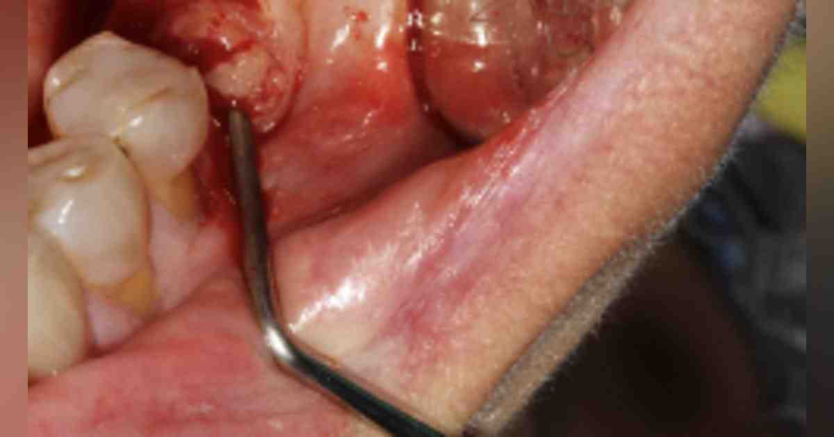 Does Medicare cover dental bridges?