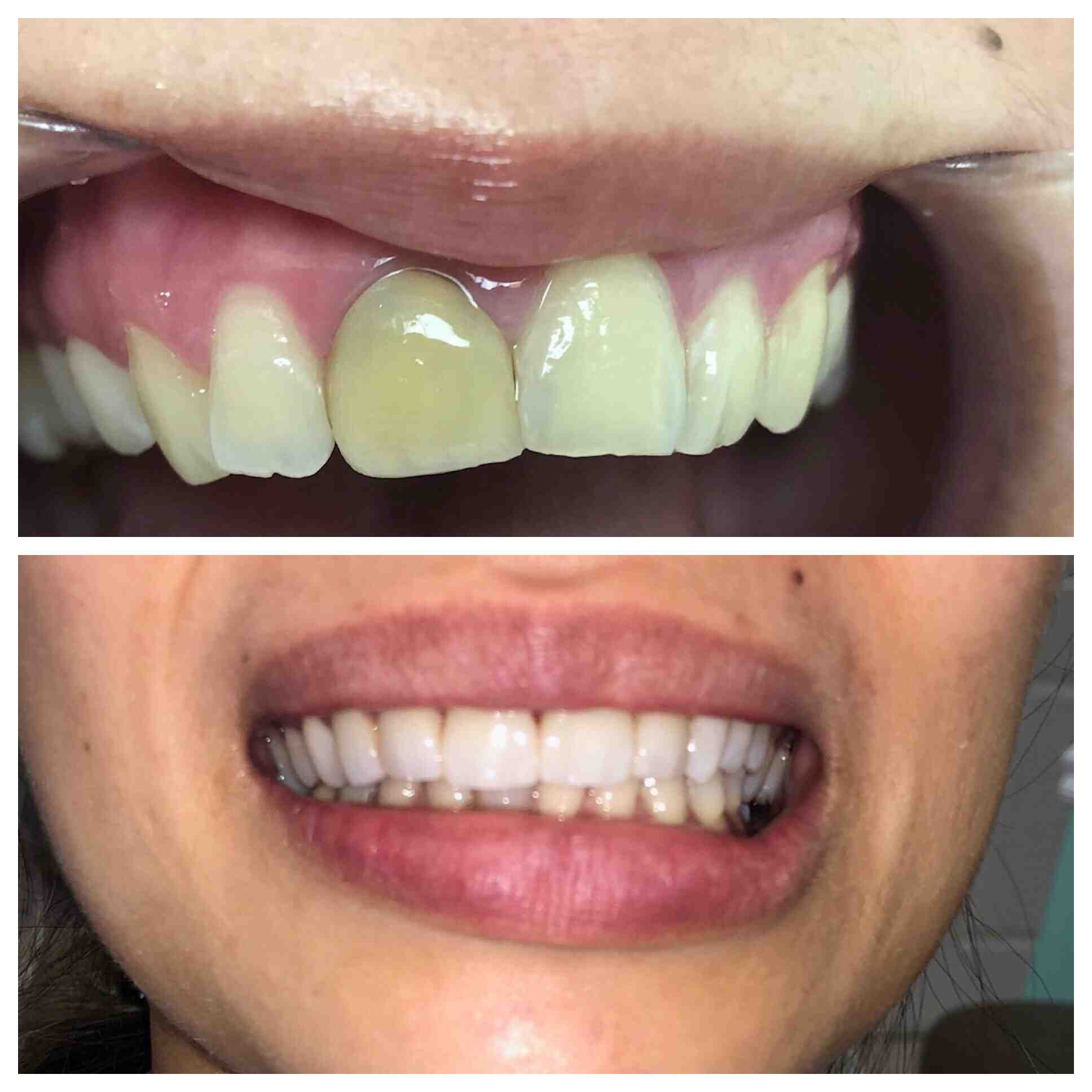Does a broken tooth have to be pulled?