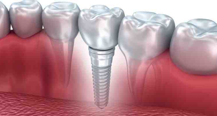 Does it hurt to get a dental implant?