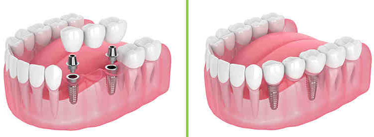 Does medicare cover dental implants removed during cancer treatment?