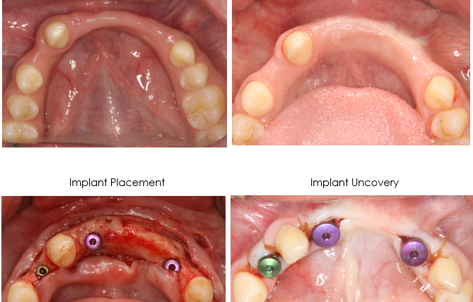 How are bone grafts for dental implants done