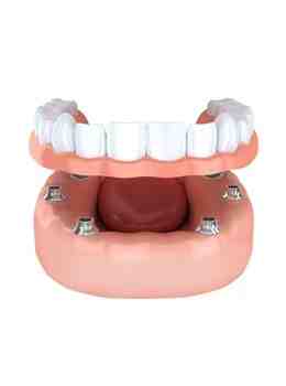 How can I get dental implants covered by insurance?