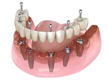 How do I know if my tooth implant is working?