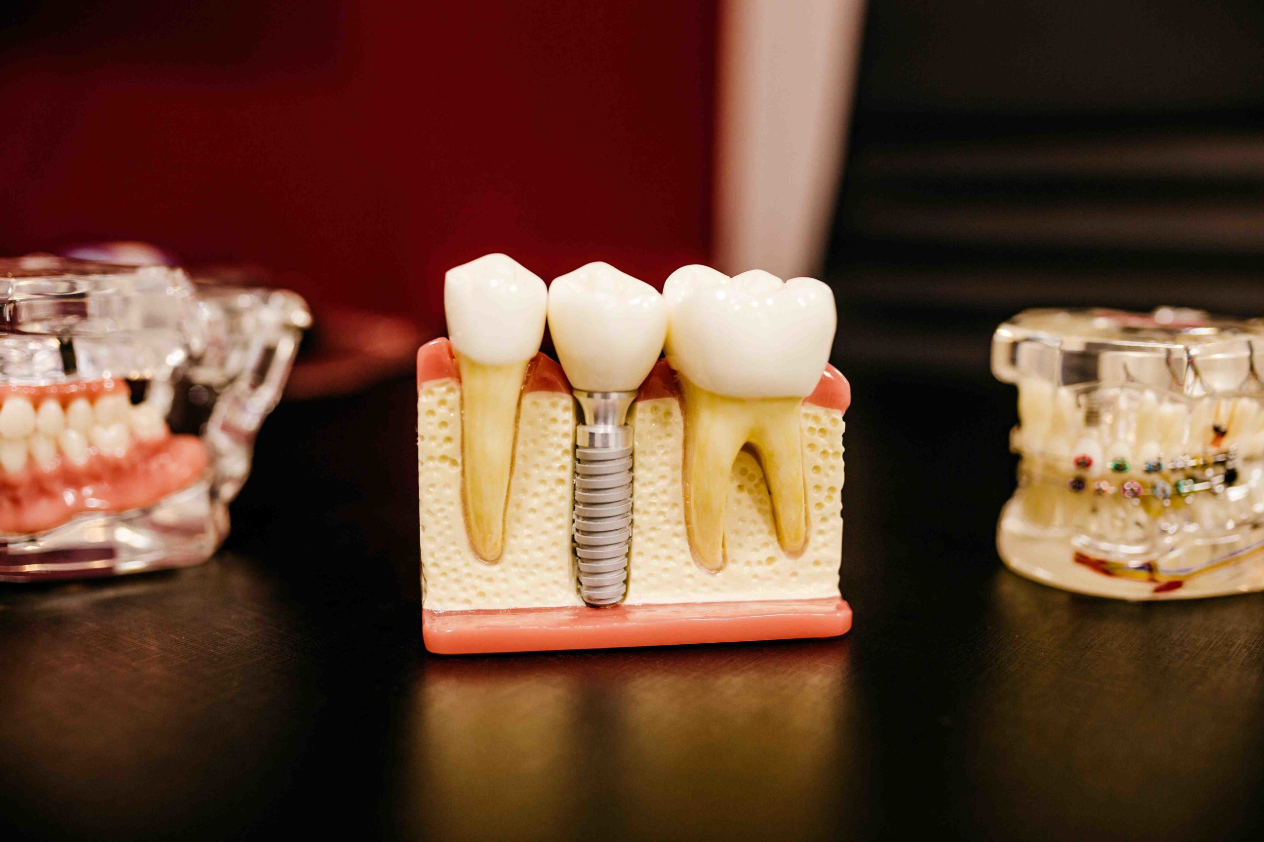 How do you confirm osseointegration?