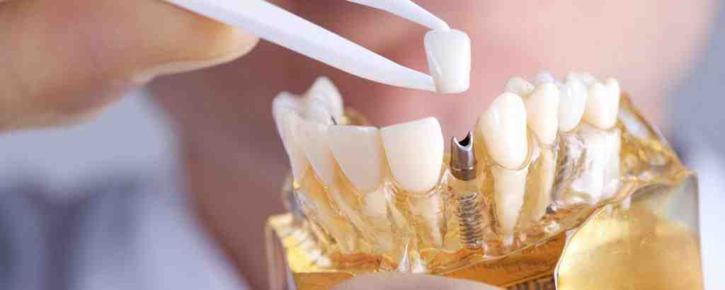 How do you feel after a dental implant?