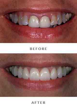 How do you fix a crown on an implant?
