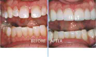 How do you fix worn out front teeth?
