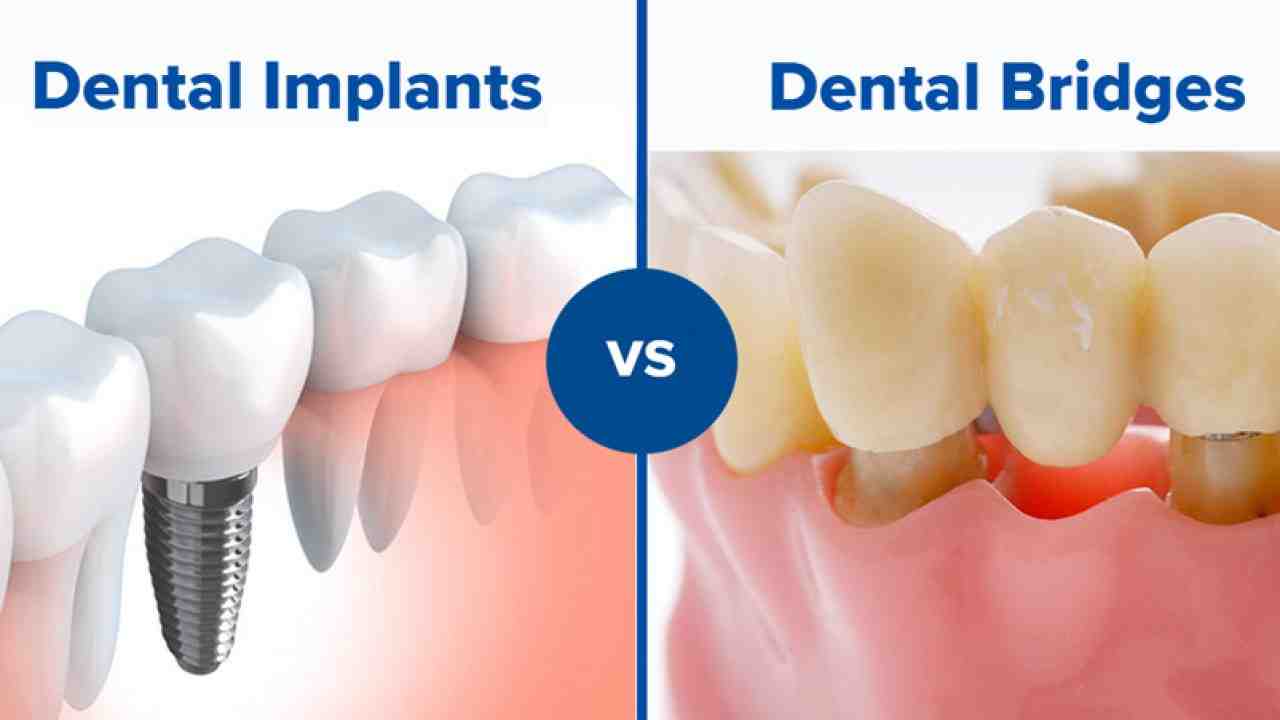 How do you floss all on 4 dental implants?