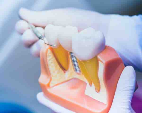 How do you know if dental implants are stable?