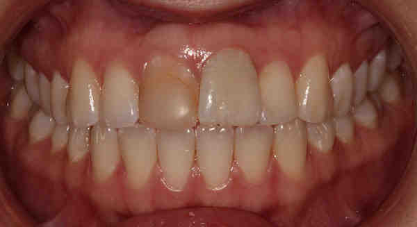 How do you use snap on smile dentures?