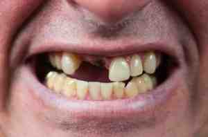 How fast do braces close gaps?