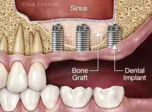 How long after bone graft can you get implant?