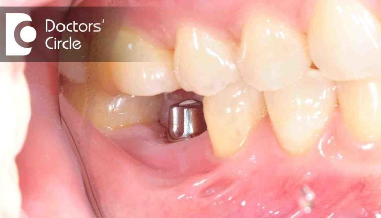 How long after full teeth extraction before dental implants